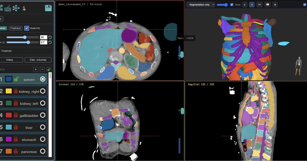 MedSeg editor with segmented medical imaging views.