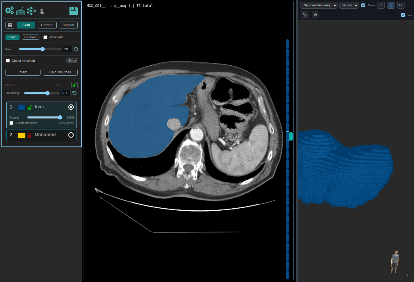 Liver mask from TotalSegmentator shown on a soft tissue CT window in the MedSeg editor.