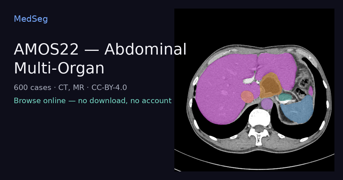 AMOS22 — Abdominal Multi-Organ — example case rendered in the MedSeg editor