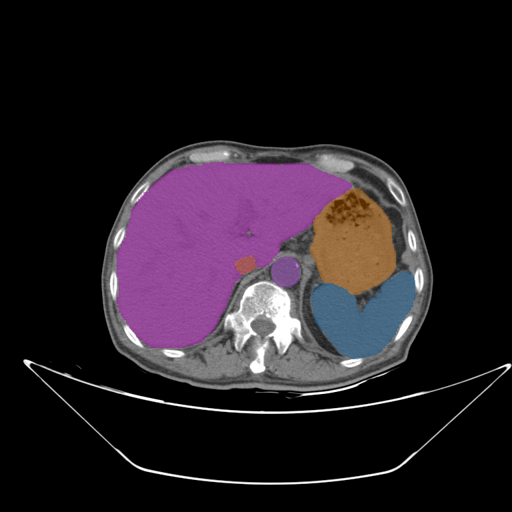 amos_0001 — AMOS22 — Abdominal Multi-Organ case preview