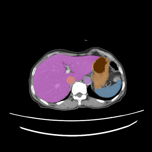 amos_0004 — AMOS22 — Abdominal Multi-Organ case preview