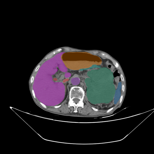 amos_0005 — AMOS22 — Abdominal Multi-Organ case preview