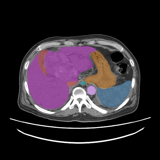 amos_0006 — AMOS22 — Abdominal Multi-Organ case preview