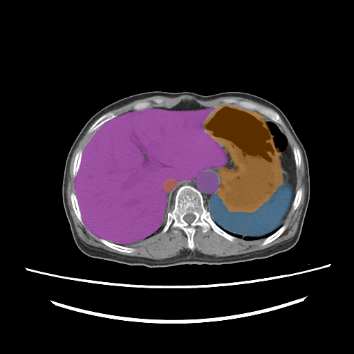 amos_0016 — AMOS22 — Abdominal Multi-Organ case preview