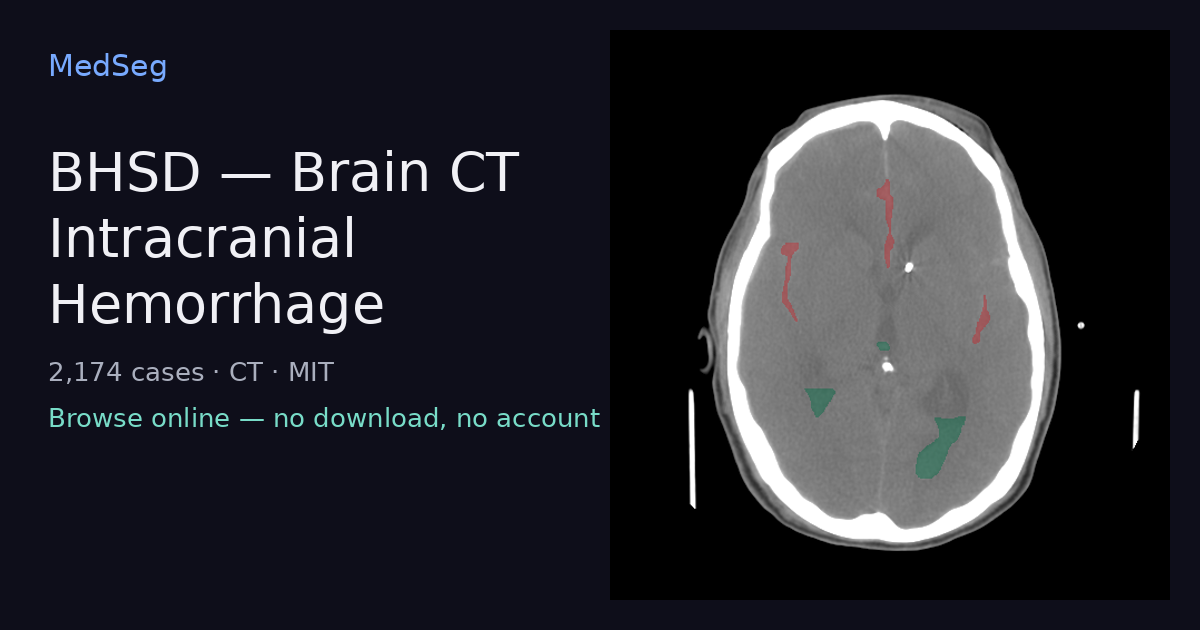 BHSD — Brain CT Intracranial Hemorrhage — example case rendered in the MedSeg editor