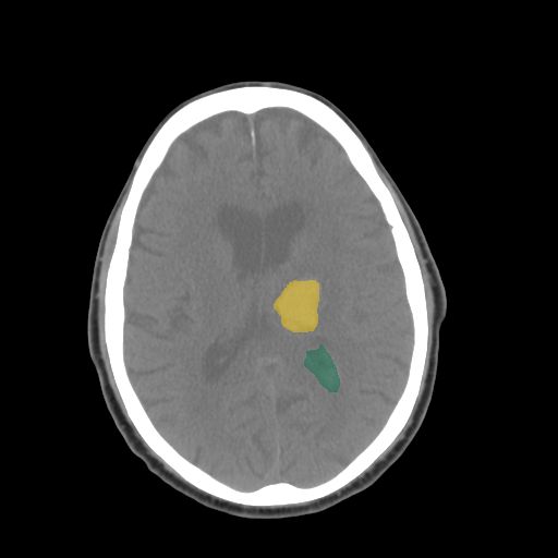 0237f3c9_40015688b9 — BHSD — Brain CT Intracranial Hemorrhage case preview