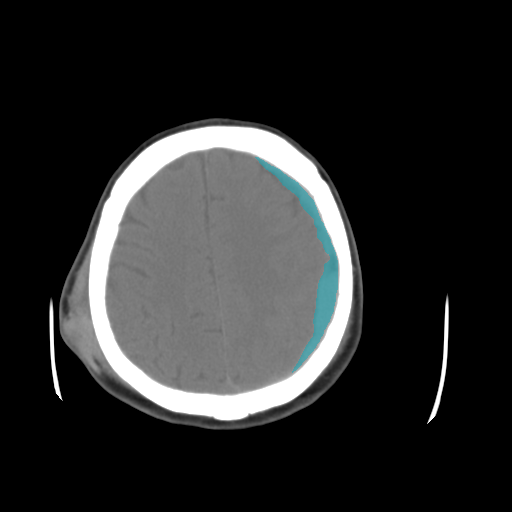 029ebbea_563afa0901 — BHSD — Brain CT Intracranial Hemorrhage case preview