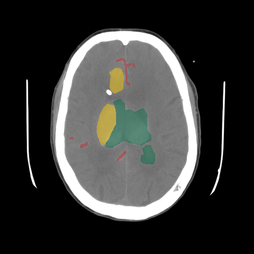 02b882cc_a4892e60ae — BHSD — Brain CT Intracranial Hemorrhage case preview