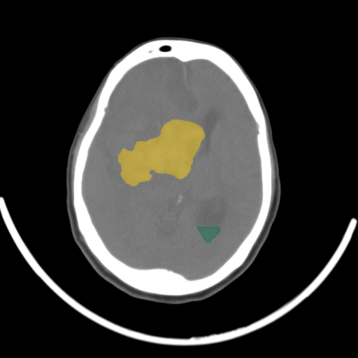 02f779fb_c4d7f33559 — BHSD — Brain CT Intracranial Hemorrhage case preview