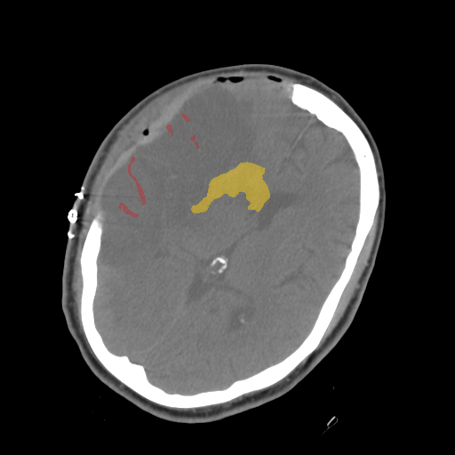 1653b22b_c35cd0de73 — BHSD — Brain CT Intracranial Hemorrhage case preview