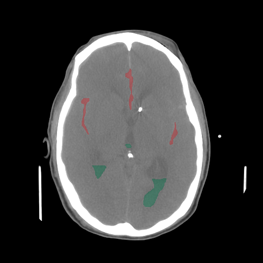 BHSD — Brain CT Intracranial Hemorrhage preview