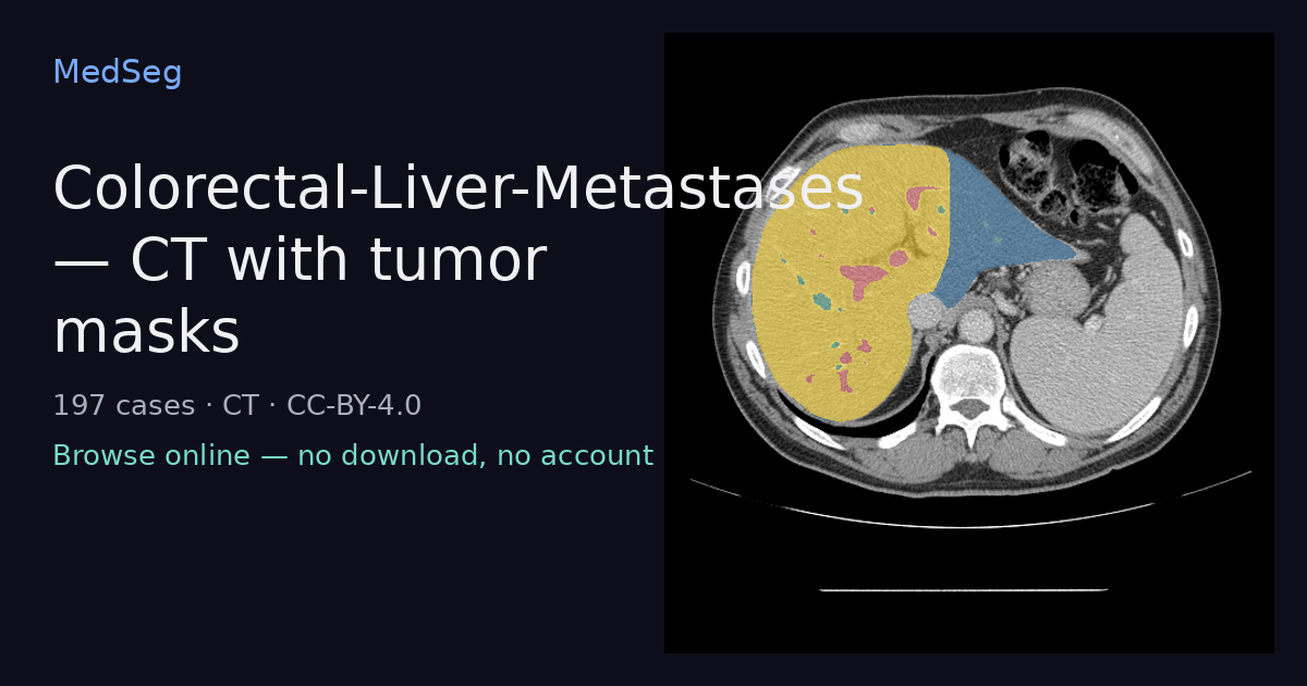 Colorectal-Liver-Metastases — CT with tumor masks — example case rendered in the MedSeg editor
