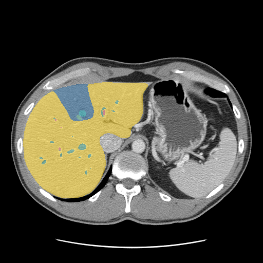 CRLM-CT-1001 — Colorectal-Liver-Metastases — CT with tumor masks case preview
