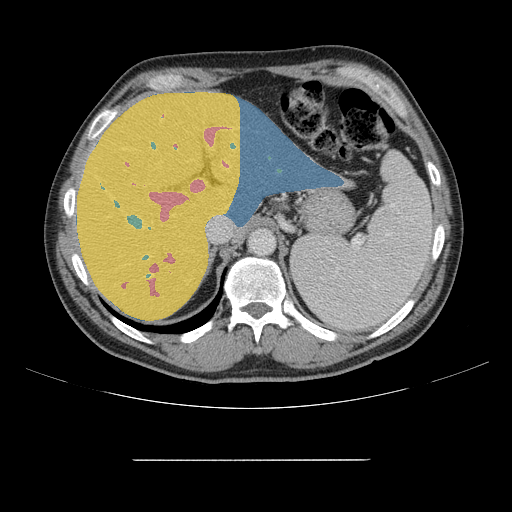 CRLM-CT-1025 — Colorectal-Liver-Metastases — CT with tumor masks case preview