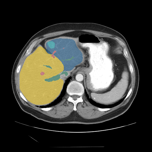 CRLM-CT-1036 — Colorectal-Liver-Metastases — CT with tumor masks case preview