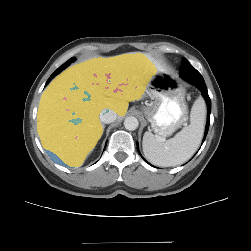 CRLM-CT-1058 — Colorectal-Liver-Metastases — CT with tumor masks case preview