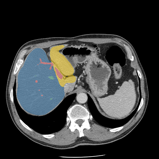 CRLM-CT-1135 — Colorectal-Liver-Metastases — CT with tumor masks case preview