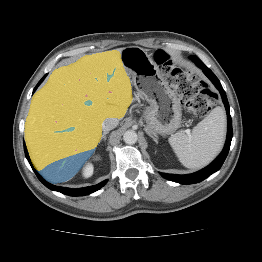 CRLM-CT-1167 — Colorectal-Liver-Metastases — CT with tumor masks case preview
