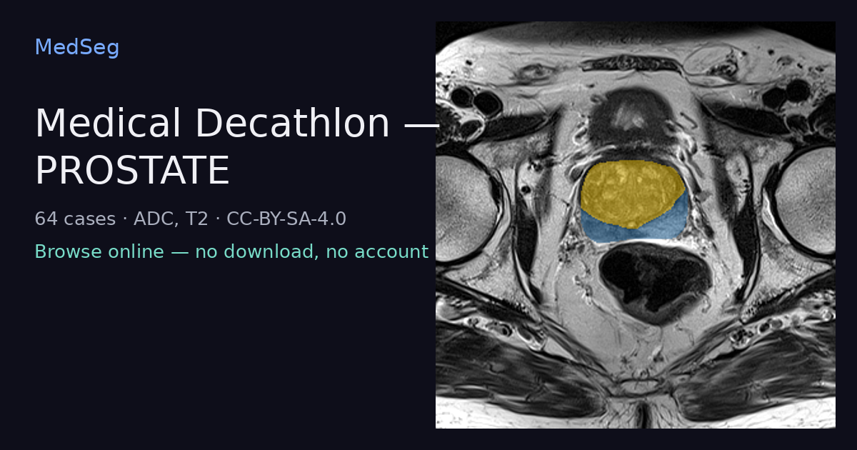 Medical Decathlon — PROSTATE — example case rendered in the MedSeg editor