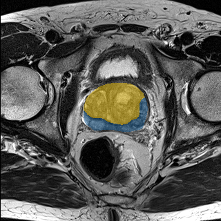 prostate_01-t2 — Medical Decathlon — PROSTATE case preview