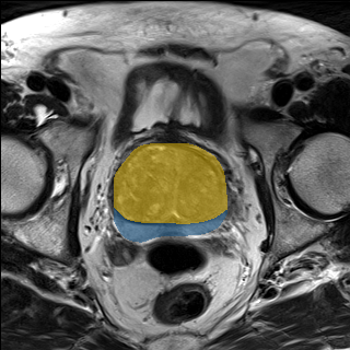 prostate_04-t2 — Medical Decathlon — PROSTATE case preview