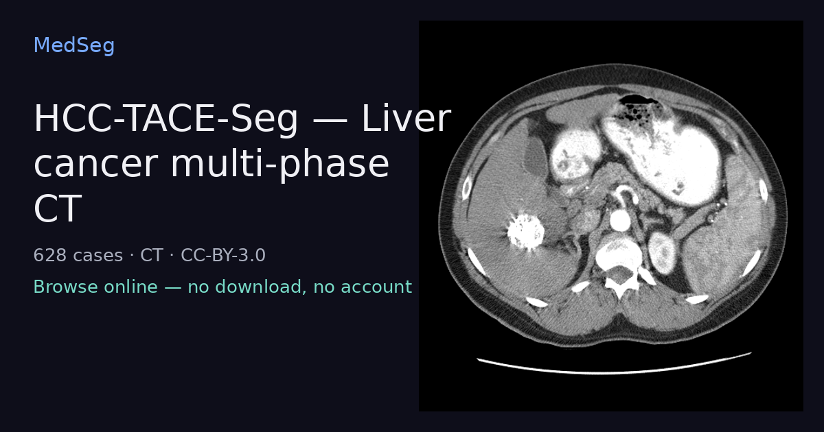 HCC-TACE-Seg — Liver cancer multi-phase CT — example case rendered in the MedSeg editor