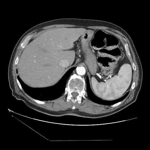HCC_001__c-a-p__acq-1 — HCC-TACE-Seg — Liver cancer multi-phase CT case preview