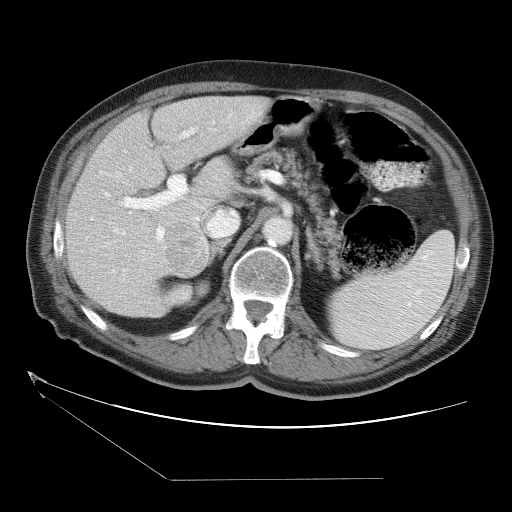 HCC_001__c-a-p__acq-2 — HCC-TACE-Seg — Liver cancer multi-phase CT case preview