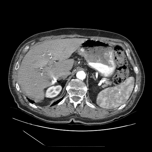 HCC_001__series__uid-45d362c7 — HCC-TACE-Seg — Liver cancer multi-phase CT case preview