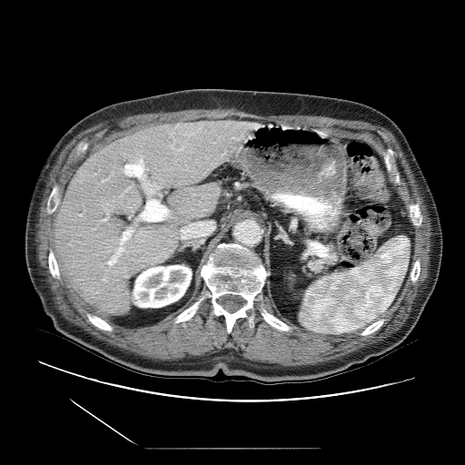 HCC_001__series__uid-b73326c6 — HCC-TACE-Seg — Liver cancer multi-phase CT case preview