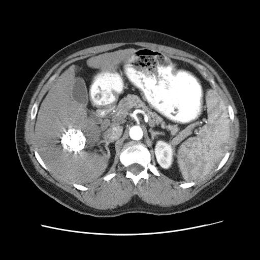 HCC-TACE-Seg — Liver cancer multi-phase CT preview