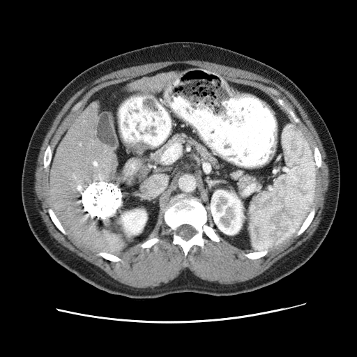 HCC_010__recon-3-liver-3-phase-ap — HCC-TACE-Seg — Liver cancer multi-phase CT case preview