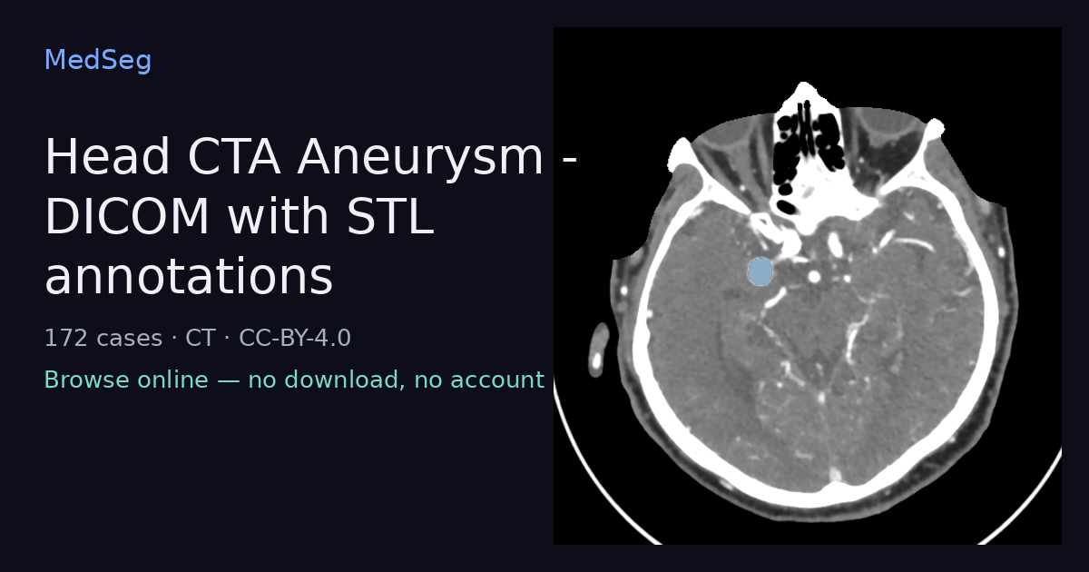 Head CTA Aneurysm - DICOM with STL annotations — example case rendered in the MedSeg editor
