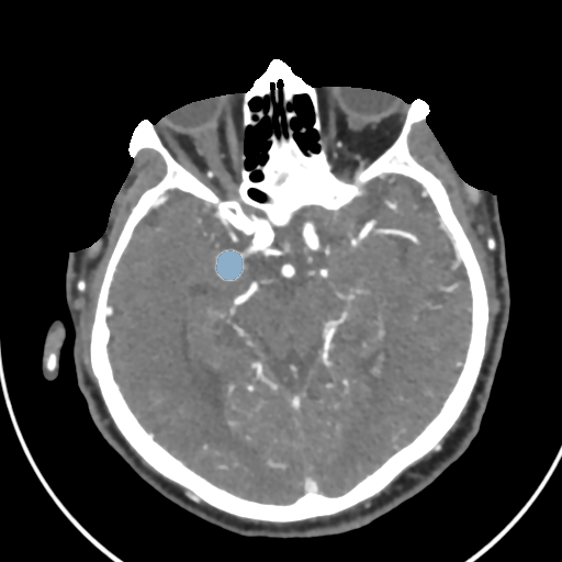 Head CTA Aneurysm - DICOM with STL annotations preview