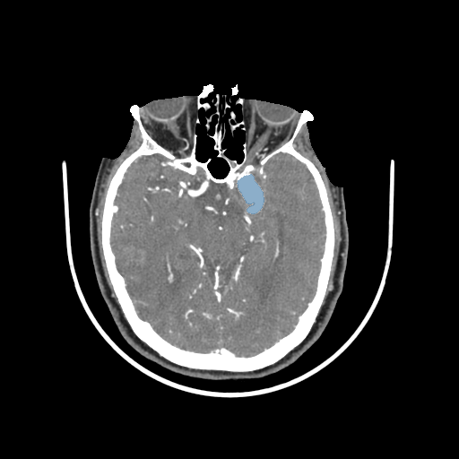 004 — Head CTA Aneurysm - DICOM with STL annotations case preview