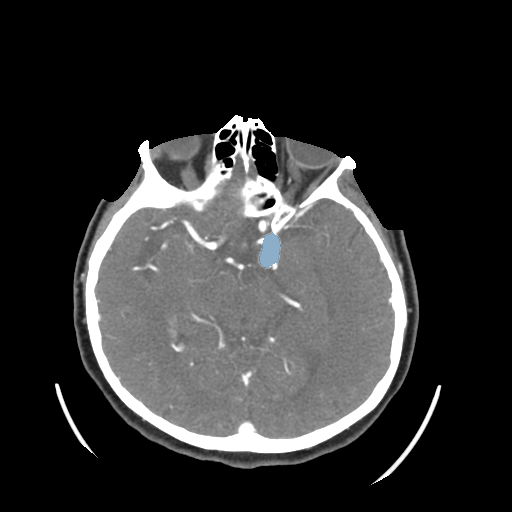 006 — Head CTA Aneurysm - DICOM with STL annotations case preview