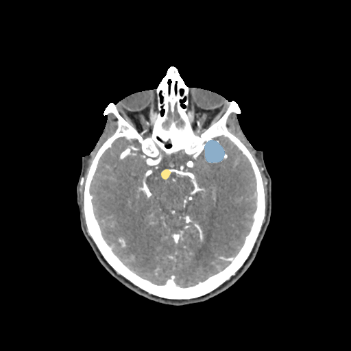 008 — Head CTA Aneurysm - DICOM with STL annotations case preview