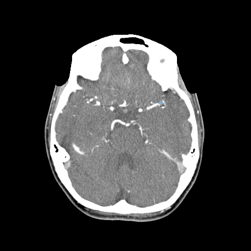 010 — Head CTA Aneurysm - DICOM with STL annotations case preview