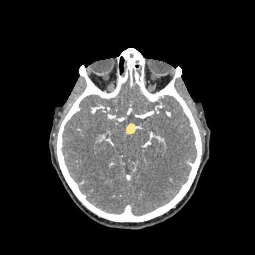 033 — Head CTA Aneurysm - DICOM with STL annotations case preview