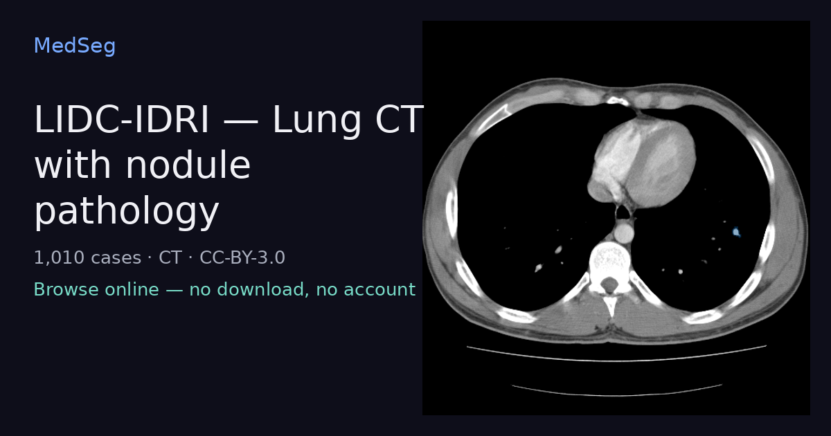 LIDC-IDRI — Lung CT with nodule pathology — example case rendered in the MedSeg editor
