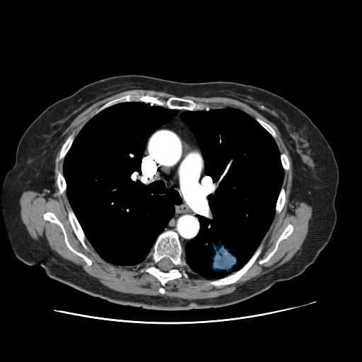 LIDC-IDRI-0001 — LIDC-IDRI — Lung CT with nodule pathology case preview