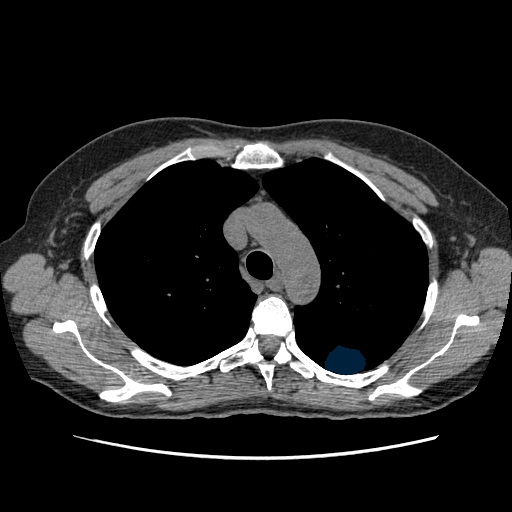 LIDC-IDRI-0002 — LIDC-IDRI — Lung CT with nodule pathology case preview