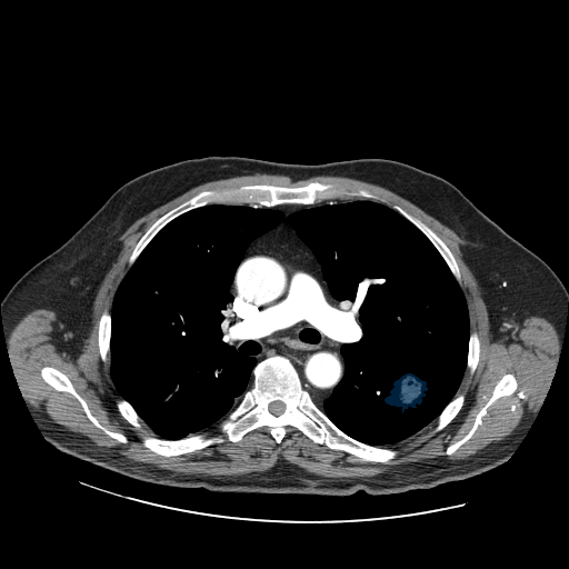 LIDC-IDRI-0003 — LIDC-IDRI — Lung CT with nodule pathology case preview