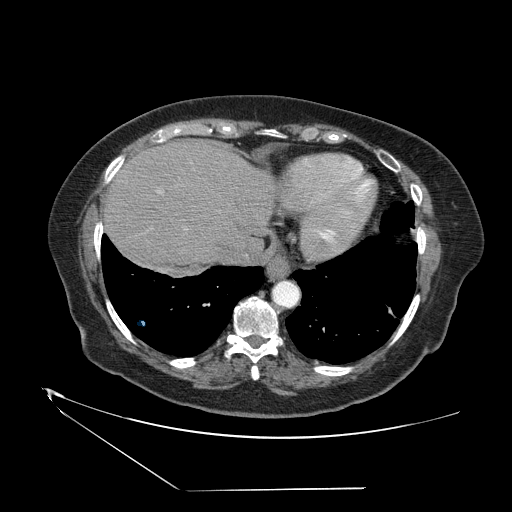 LIDC-IDRI-0004 — LIDC-IDRI — Lung CT with nodule pathology case preview