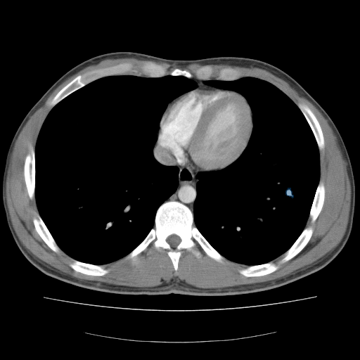 LIDC-IDRI — Lung CT with nodule pathology preview