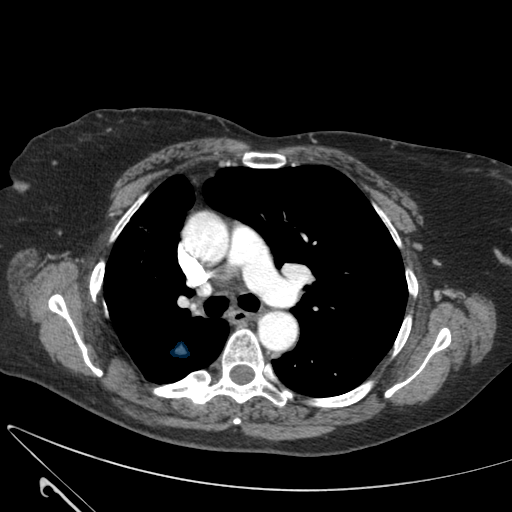 LIDC-IDRI-0888 — LIDC-IDRI — Lung CT with nodule pathology case preview