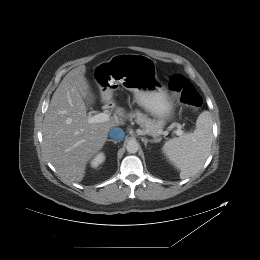 case-01 - MedSeg Inferior Vena Cava case preview