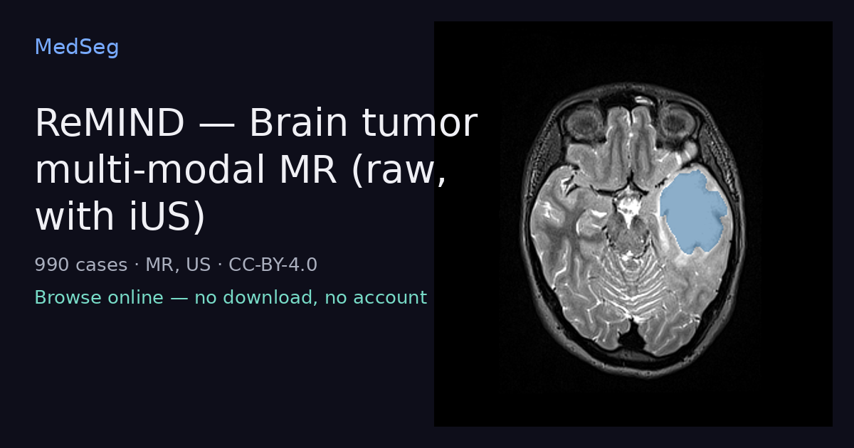 ReMIND — Brain tumor multi-modal MR (raw, with iUS) — example case rendered in the MedSeg editor