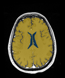 ReMIND-001__3d-ax-t1-postcontrast — ReMIND — Brain tumor multi-modal MR (raw, with iUS) case preview