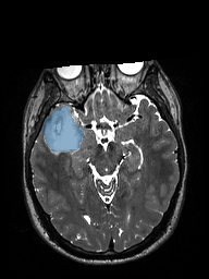 ReMIND-001__3d-sag-t2-space — ReMIND — Brain tumor multi-modal MR (raw, with iUS) case preview